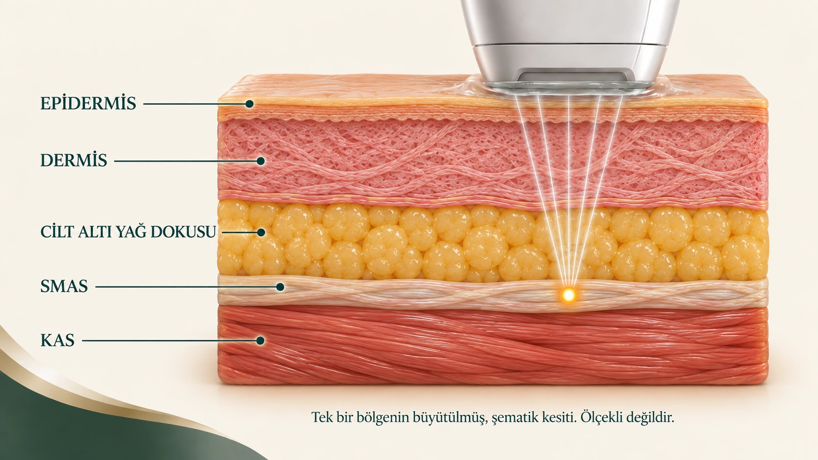 Tek bir bölgenin büyütülmüş şematik kesitinde epidermis, dermis, cilt altı yağ dokusu, SMAS ve kas; SMAS düzeyinde örnek ultrason odağı
